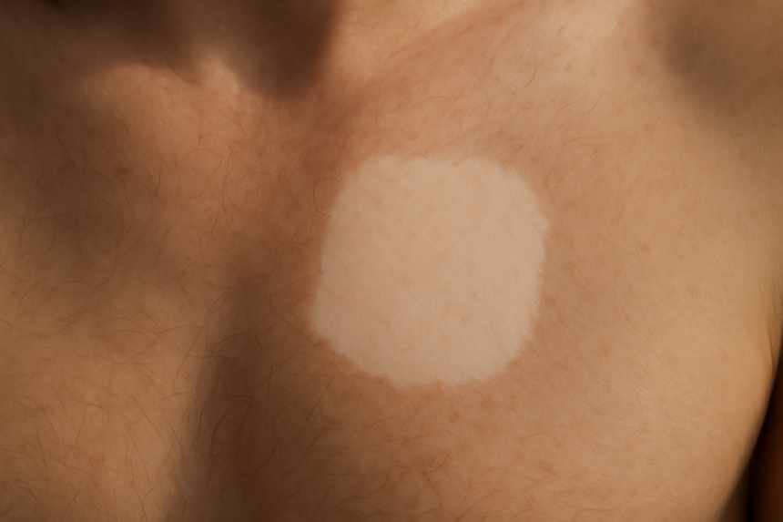 pale chest birthmark